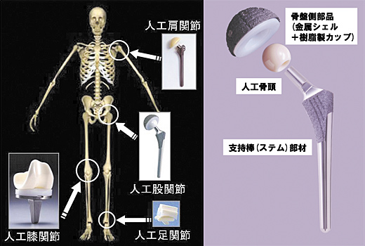 人工関節